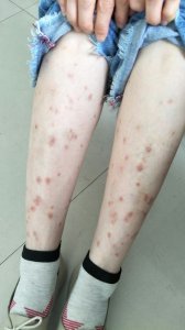 ​中草药外洗帮你赶走春季桃花癣