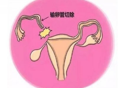 ​输卵管堵塞怎么治疗最好的方法？输卵管堵塞怎么治疗呢